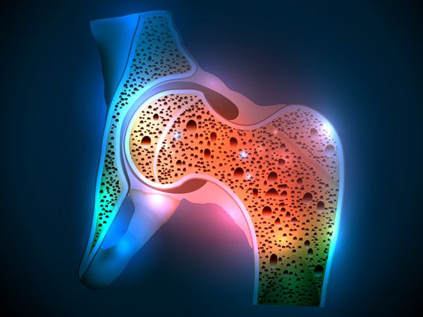 Schmerzhafte Ostheoporose
